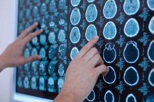 Todo sobre el gliobastoma y los gliomas
