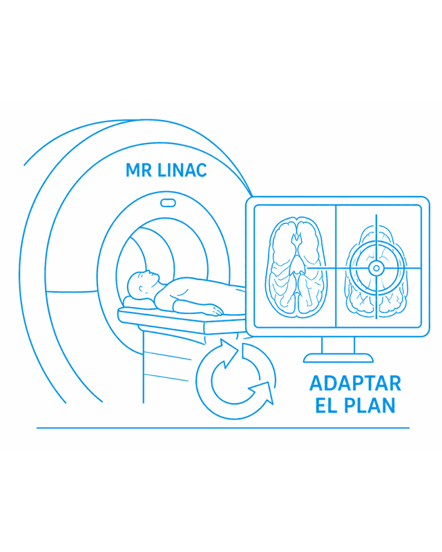 Radioterapia adaptativa MR Linac